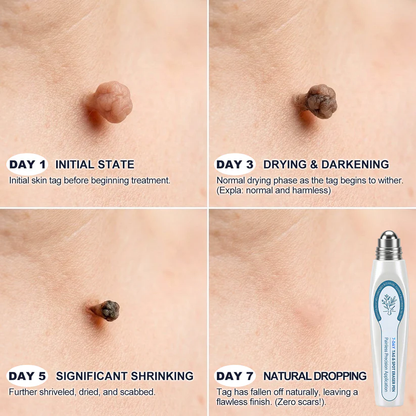 𝐎𝐟𝐟𝐢𝐜𝐢𝐚𝐥 𝐁𝐫𝐚𝐧𝐝 𝐒𝐭𝐨𝐫𝐞 | Madicuba™ 7-Day Skin Tag & Spot Eraser Painless & Scar-Free Advanced Imperfection Remova𝗜 Ro𝗜𝗜erba𝗜𝗜 Pen